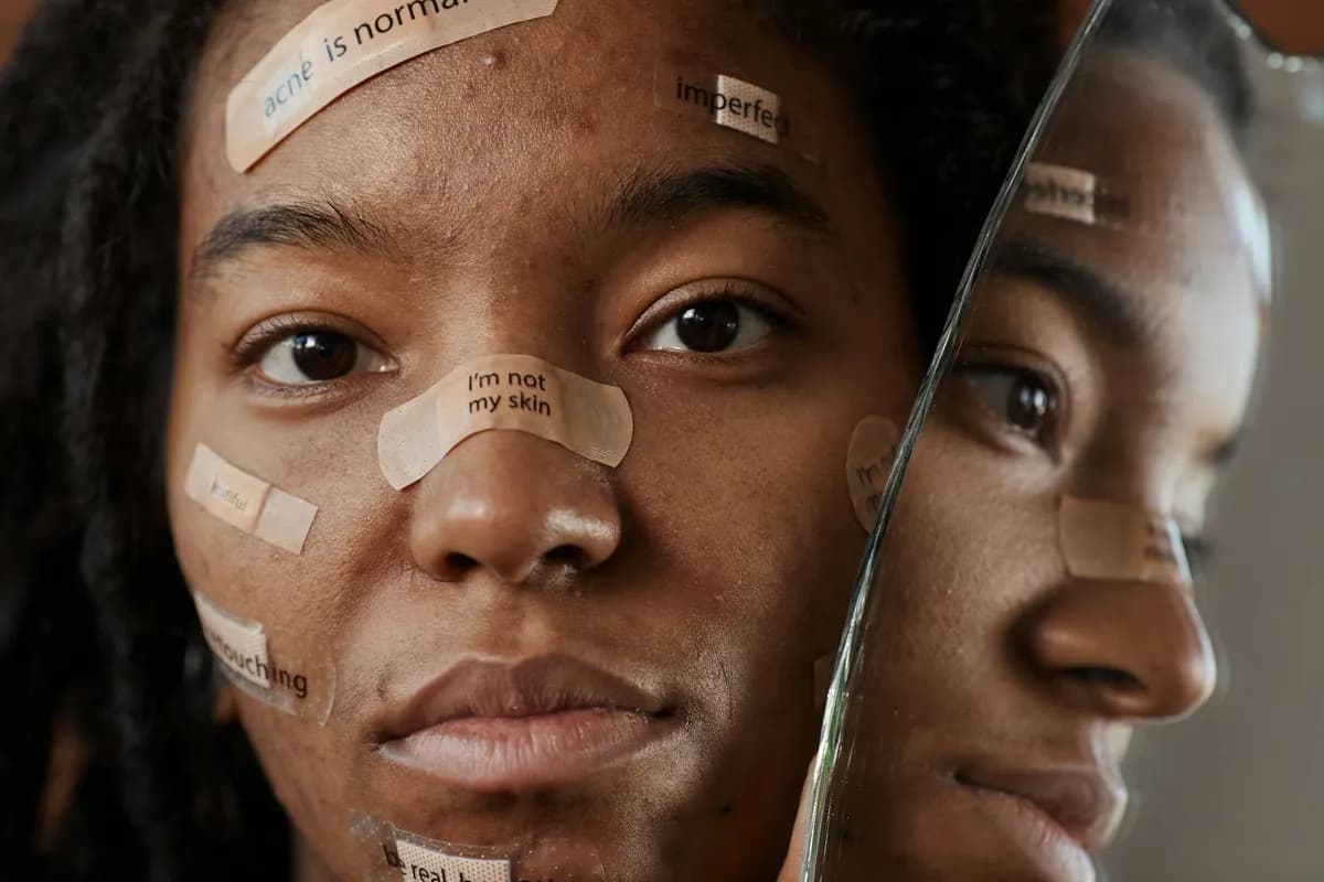 Acne — health condition