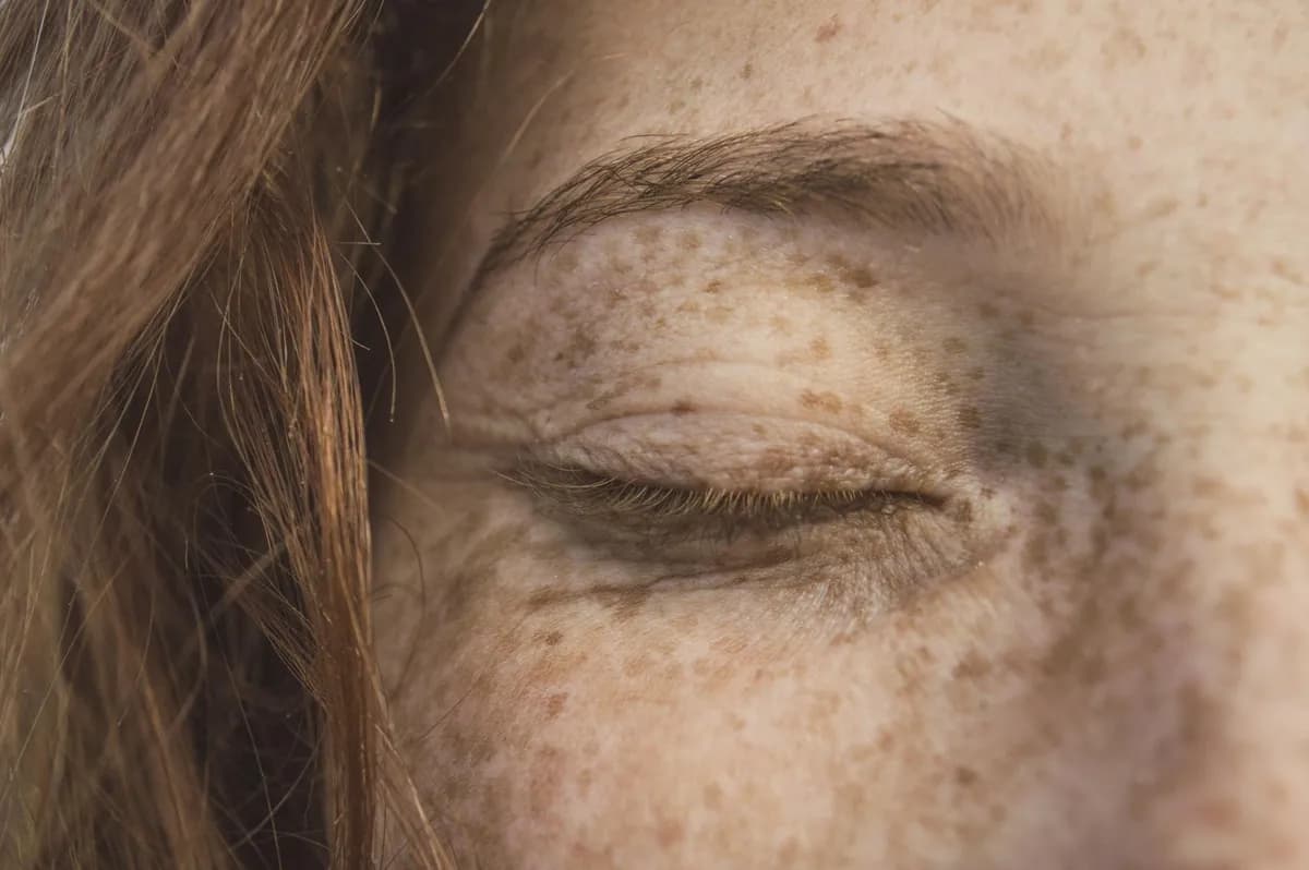 Chloasma — health condition