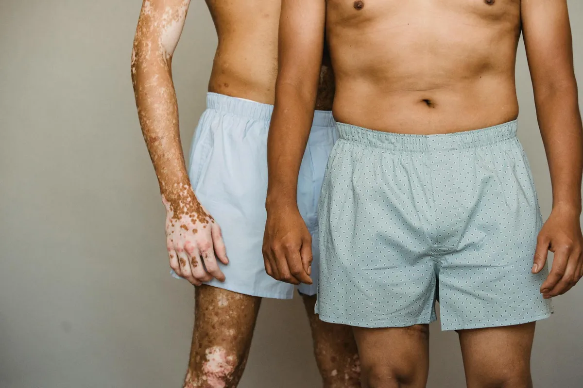 Psoriasis — health condition
