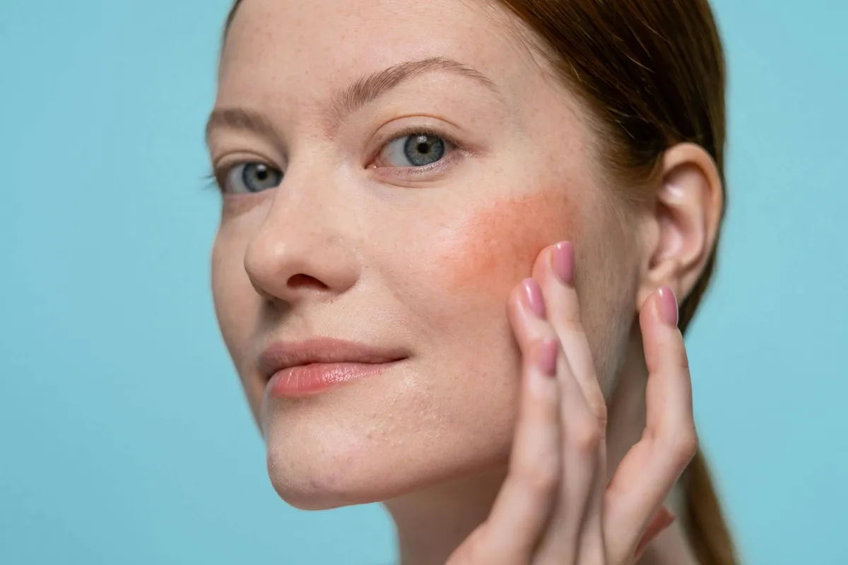 Rosacea — health condition