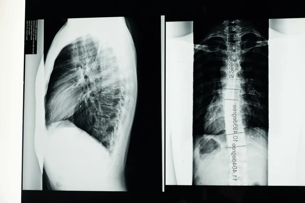 Scoliosis — health condition