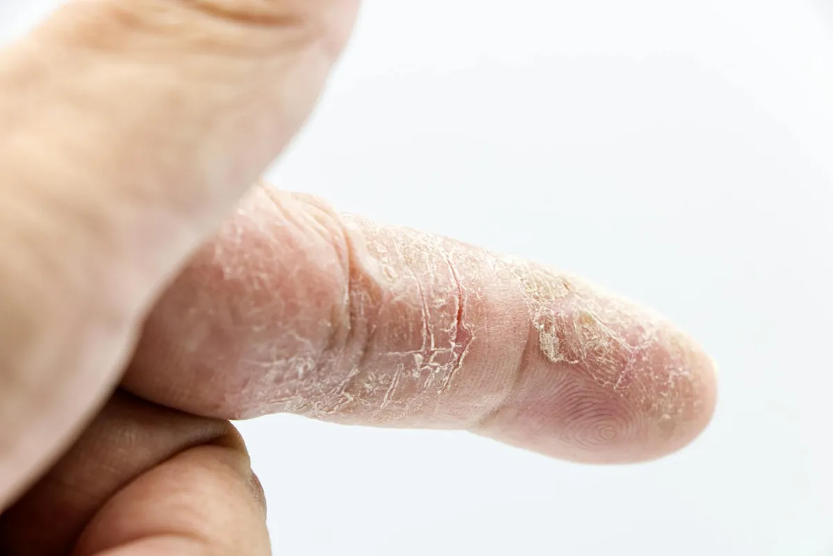 Dry Skin — health symptom