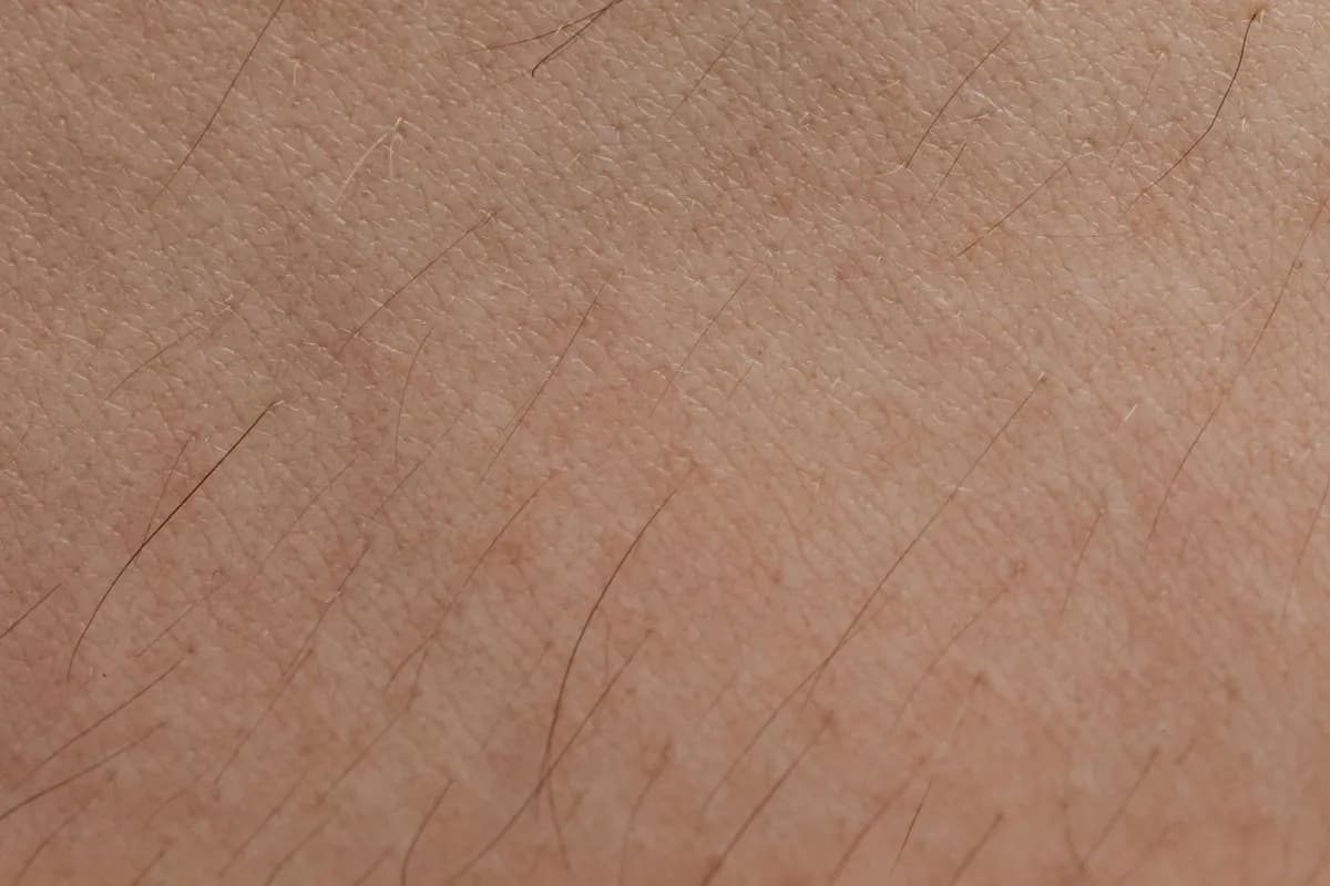 Excess Hair — health symptom