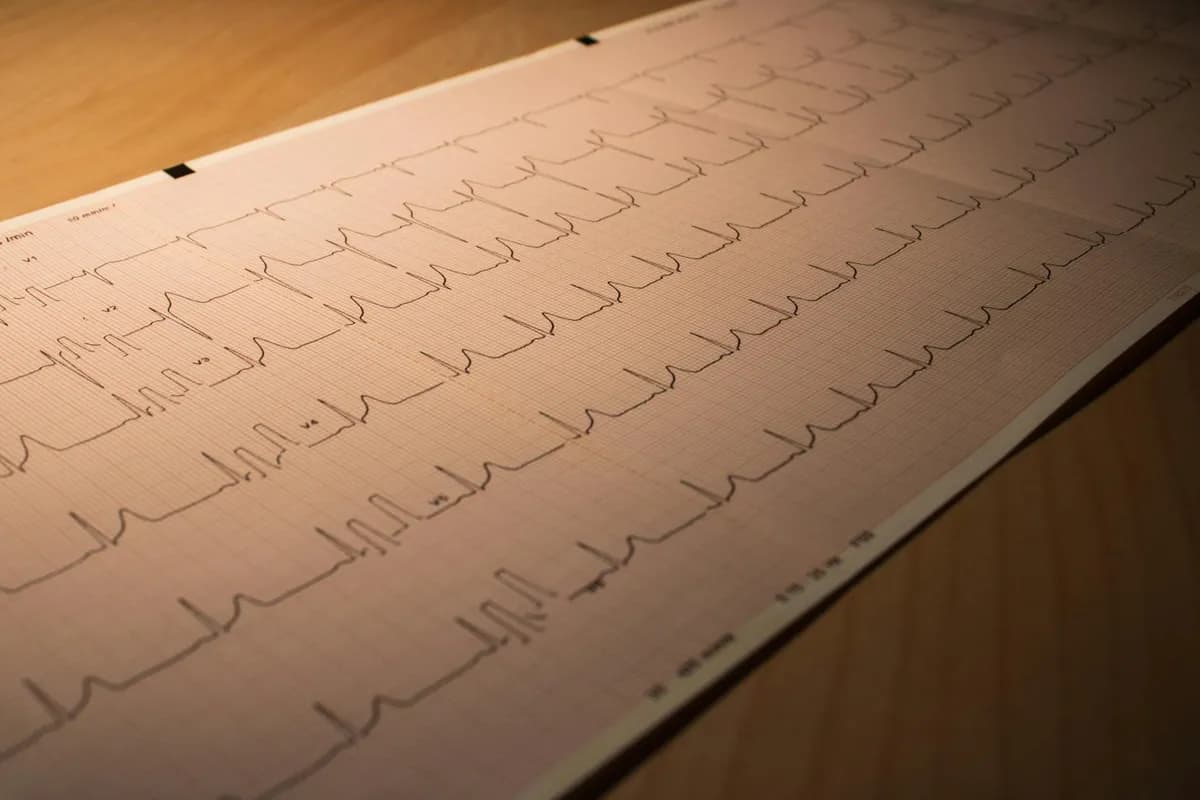 Palpitations — health symptom