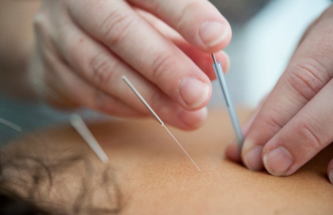 Does Acupuncture Support Stress and Chronic Pain? — holistic health