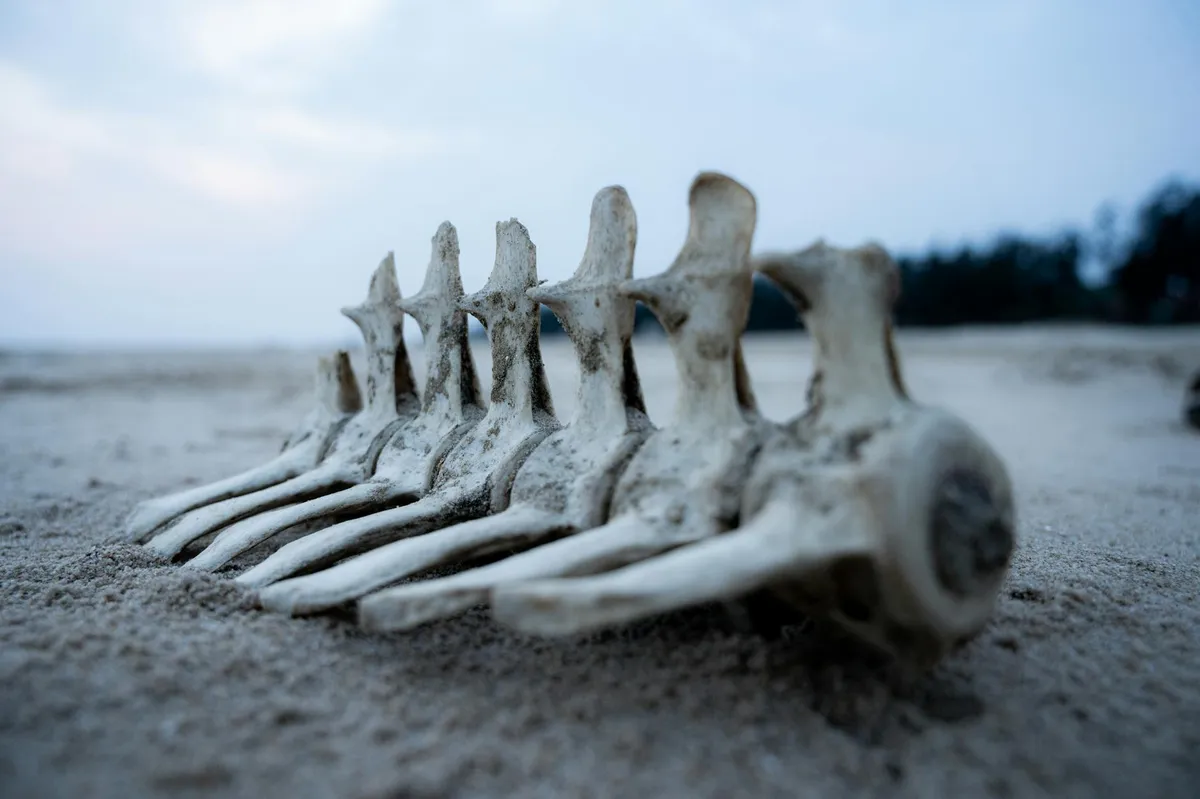 Osteoporosis — health condition