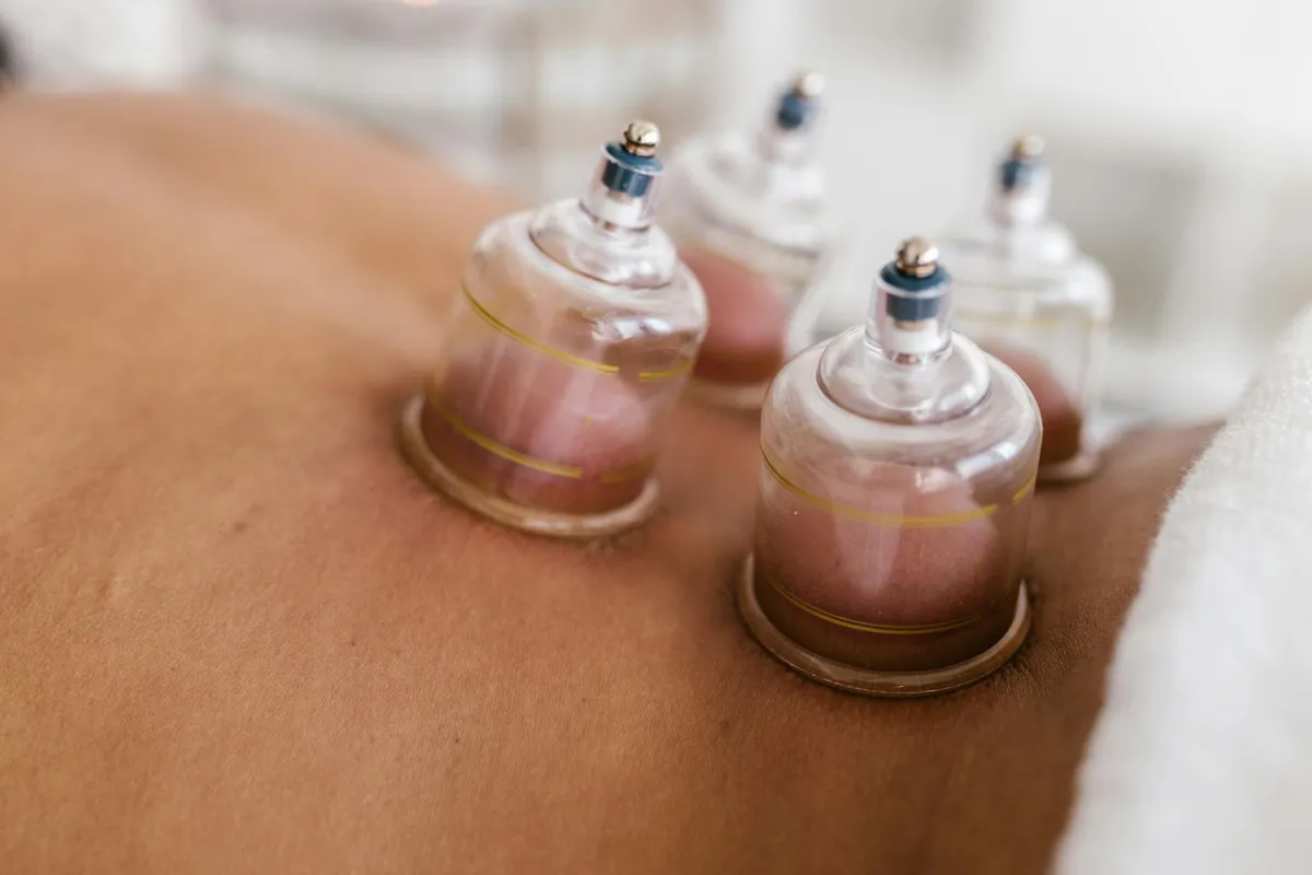 Cupping therapy — Holistic health practice