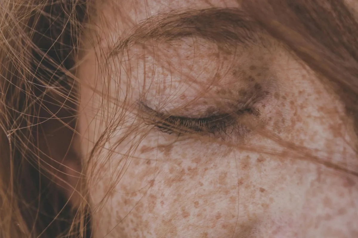 Melasma — health symptom