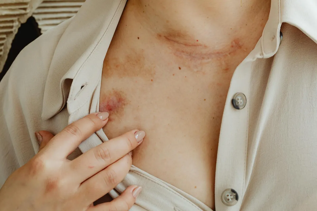 Non Healing Wound — health symptom