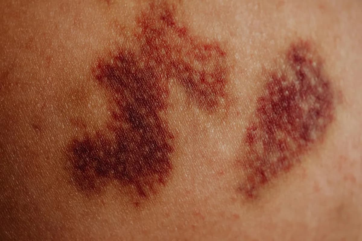 Rash — health symptom