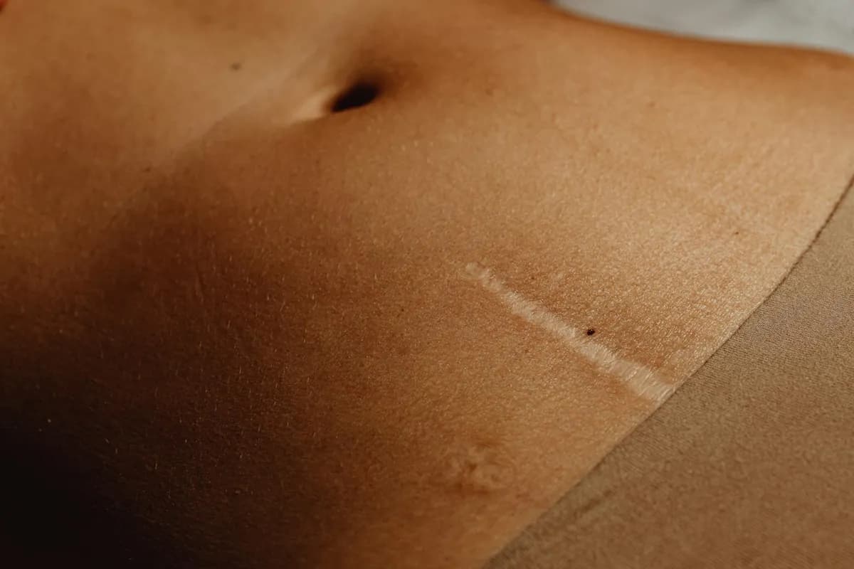 Scarring — health symptom