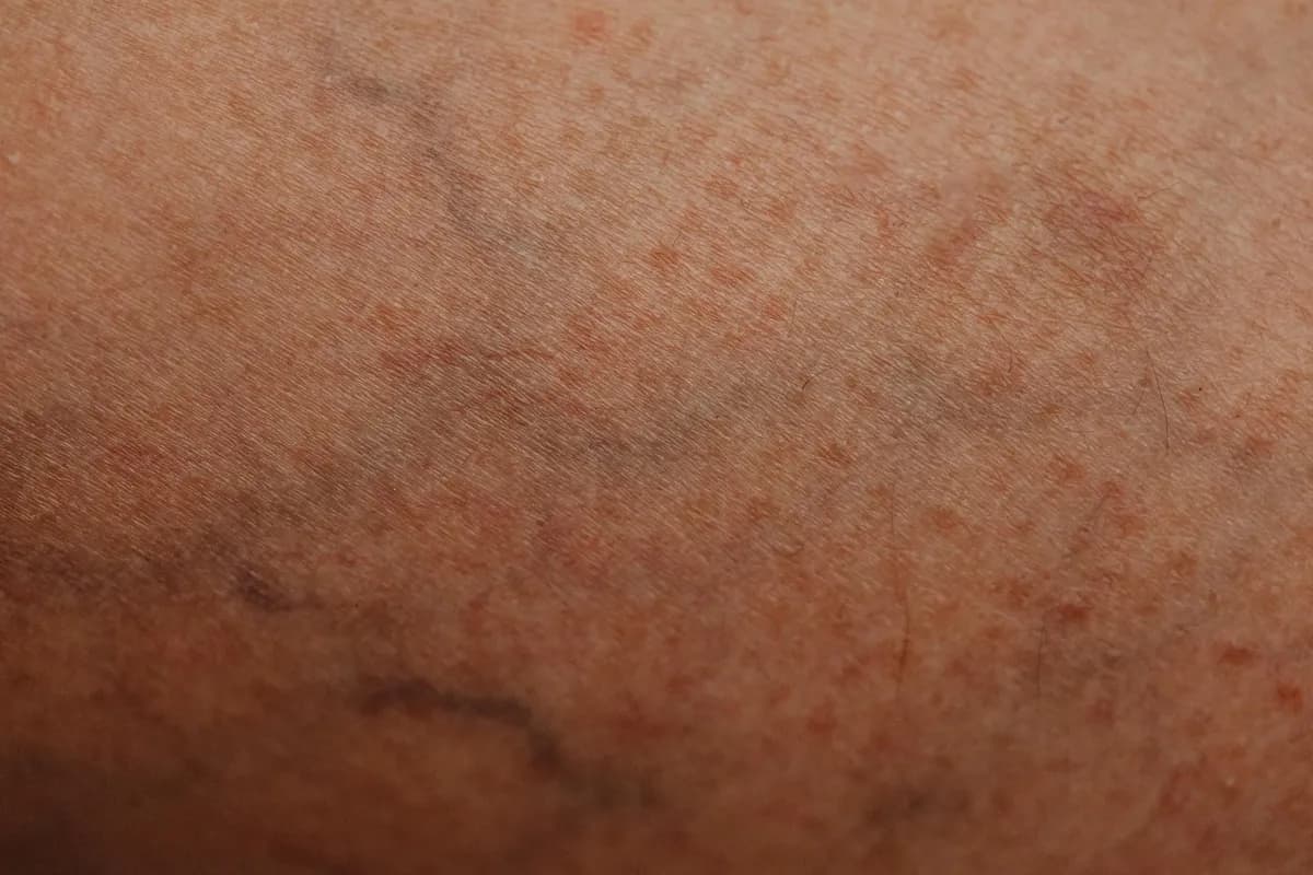 Thickened Skin — health symptom
