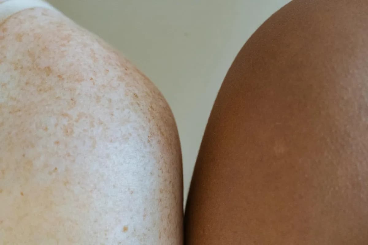 Uneven Skin Tone — health symptom