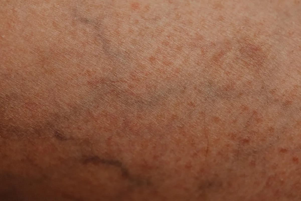 Visible Vessels — health symptom